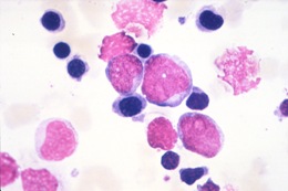 AML blood films, image courtesy SA Pathology