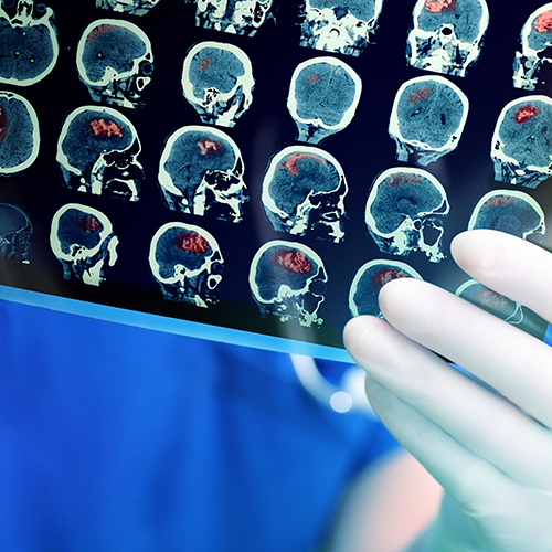 brain cancer MRI - shutterstock_390249514_web.jpg