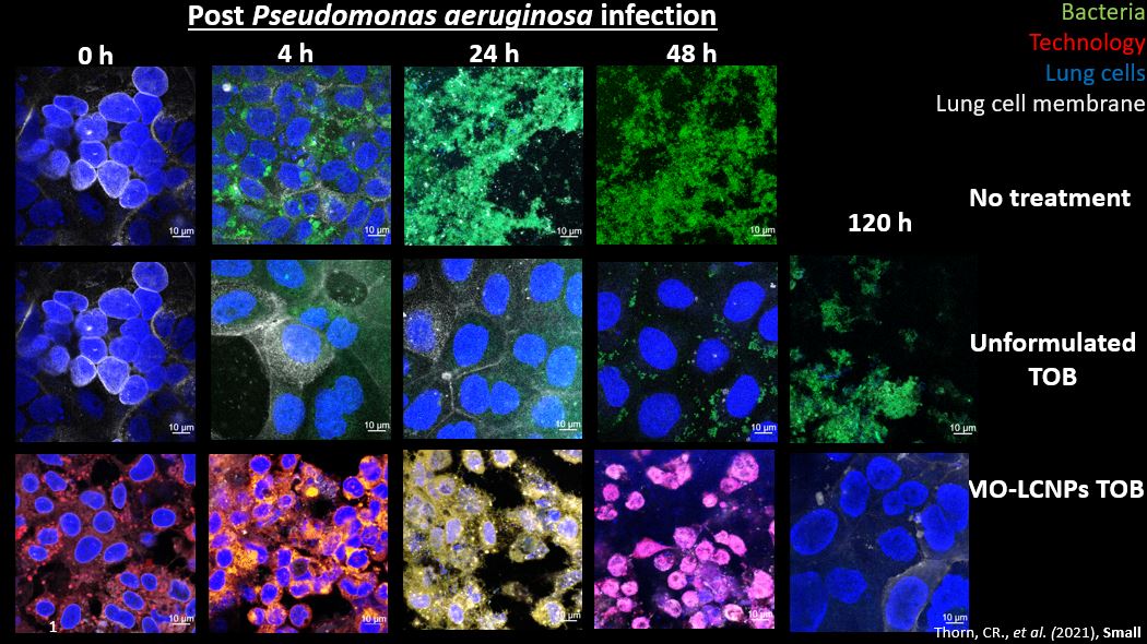 Cystic fibrosis cells under treatment