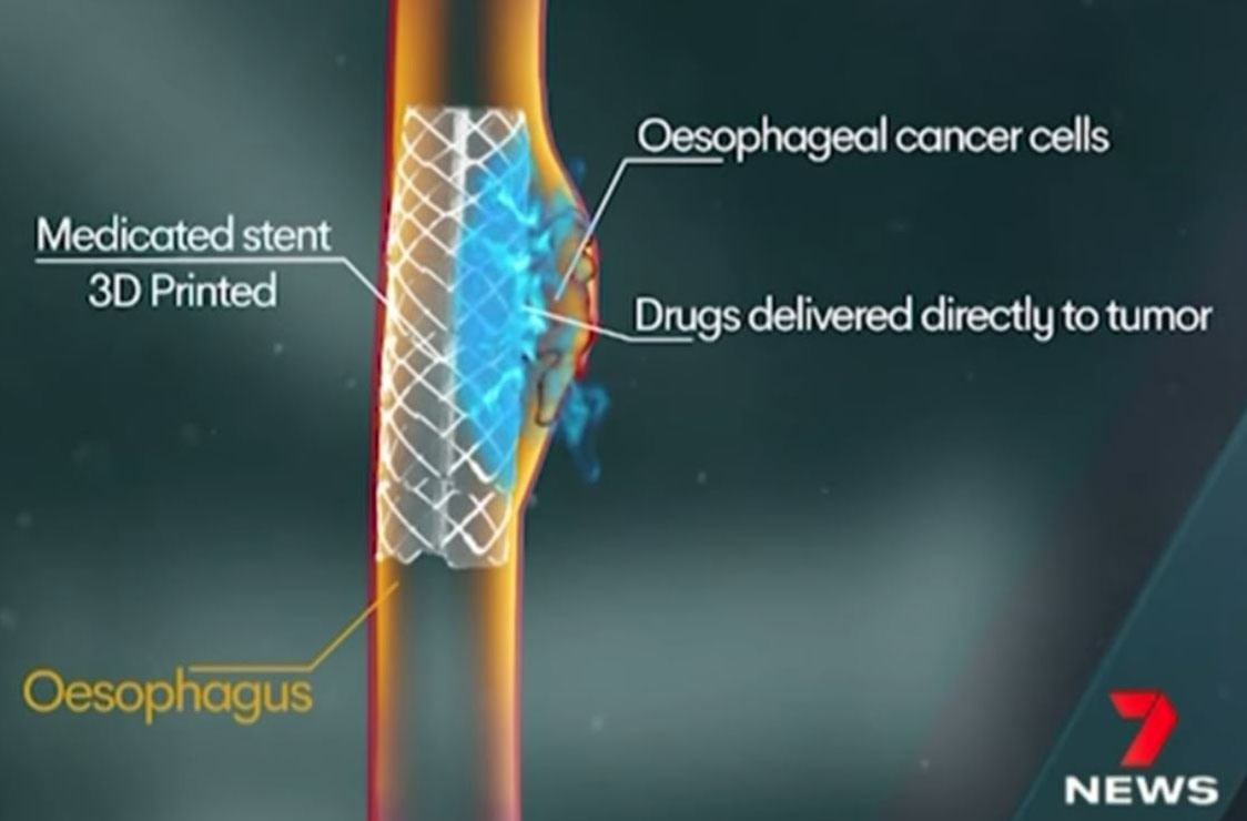 Newswise: Novel 3D printed stents deliver breakthrough treatment for oesophageal cancer