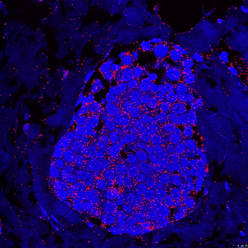 human breast cancer with CXCR4CCR7 heterodimers_web.jpg