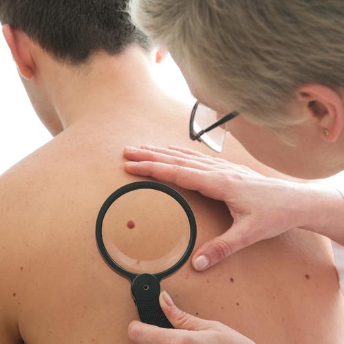 skin cancershutterstock_121287184.jpg