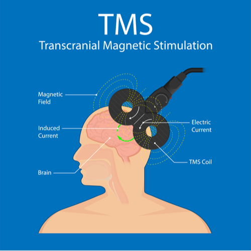 Large doses of repetitive trans cranial magnetic stimulation significantly improve post-stroke depression.