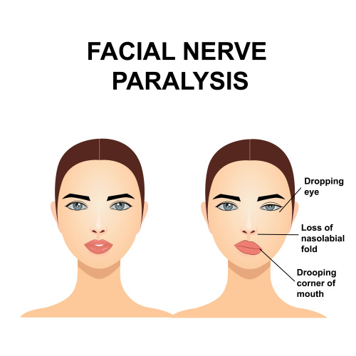 facial paralysis 2_500x500.jpg