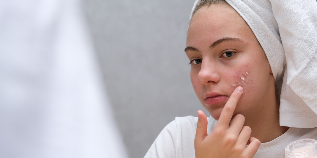 Teenager girl with acne